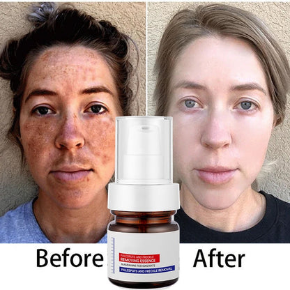 Sérum pour le visage blanchissant à la vitamine C, élimine les tâches brunes du mélasma et éclaircit la mélanine